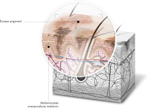 Skin Discoloration Skin Discoloration