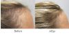 Professional Hair Growth Program