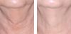 Nectifirm® before and after #3