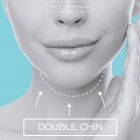 CoolSculpting® Double Chin Treatment