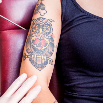 Laser Tattoo Removal