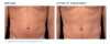 EMSCULPT®