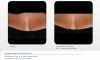 Resurfx before & after 3