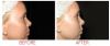 Collagen P.I.N. Microneedling Before & After 1