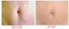 Collagen P.I.N. Microneedling Before & After 2