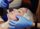 SkinPen®  Microneedling
