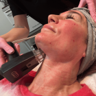 Morpheus8 RF Microneedling