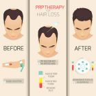 PRP Hair Restoration