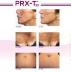 PRX WiQO Derm Perfexion Full Face