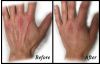 Radiesee Hand Rejuvenation Before & After