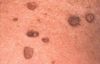 Skin Tag