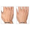 Radiesee Hand Rejuvenation Before & After