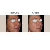 Photofractional Before and After Three