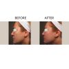 Photofractional Before and After Five