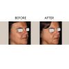 Photofractional Before and After Six