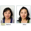 The Perfect Peel Before & After