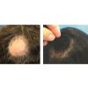 Platelet Rich Plasma (PRP) Hair Restoration Before & After
