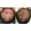 Platelet Rich Plasma (PRP) Hair Restoration Before & After