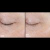 Skinbetter Science® Trio Rebalancing Moisture Treatment™ FACE Before & After