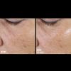 Skinbetter Science® Trio Rebalancing Moisture Treatment™ FACE Before & After