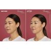 Restylane® Contour Before/After