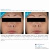 SkinCeuticals Advanced Corrective Peel
