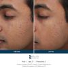 SkinPen Before & After