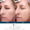 SkinPen Before & After