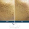 SkinPen Before & After