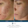 SkinPen Before & After