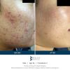SkinPen Before & After