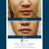 SkinPen Before & After