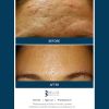 SkinPen Before & After