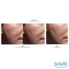 Bellafill® Dermal Filler