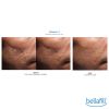 Bellafill® Dermal Filler