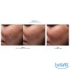 Bellafill® Dermal Filler