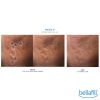 Bellafill® Dermal Filler