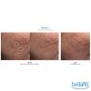 Bellafill® Dermal Filler