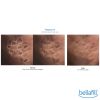 Bellafill® Dermal Filler