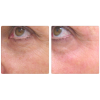 ClearLift Face before and after