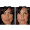 Bellafill® Dermal Filler