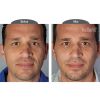 Bellafill® Dermal Filler