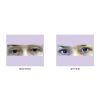 Blepharoplasty (Eye Lift) Consultation Before & After 2