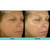 Blue Peel Radiance Before & After