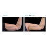 EMSCULPT®