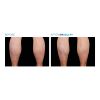 EMSCULPT®