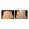 EMSCULPT®