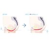 EMSCULPT®