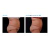 EMSCULPT®