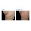 EMSCULPT®